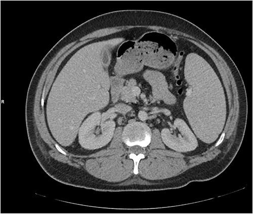 A repeat CT abdomen with IV contrast was performed which was largely unchanged from the previous scan, save for mild pericholecystic fluid.