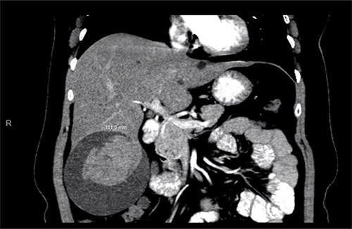 Abdominal CT scan showing a large cyst 12 × 11 × 10 cm in the right hepatic lobe with a hemorrhagic component.