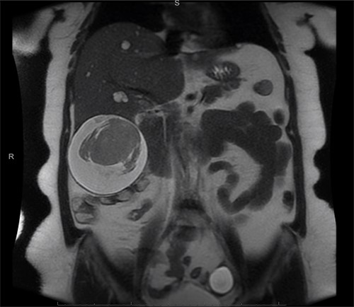 Exophytic peripheral cystic lesion with central solid non-enhancing component in inferior right lobe of the liver.