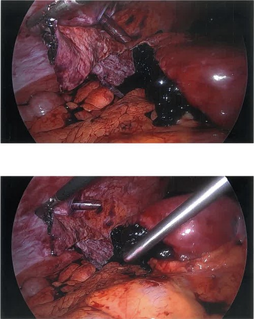 Ruptured hemorrhagic hepatic cyst wall and remaining hemorrhagic component mid-suctioning.