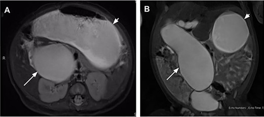 Magnetic resonance cholangiopancreatography on day of life (DOL) 36 in coronal (A) and axial (B) views showing a massive fusiform dilatation of the common bile duct (long arrow) and markedly distended stomach (short arrow) consistent with gastric outlet obstruction.