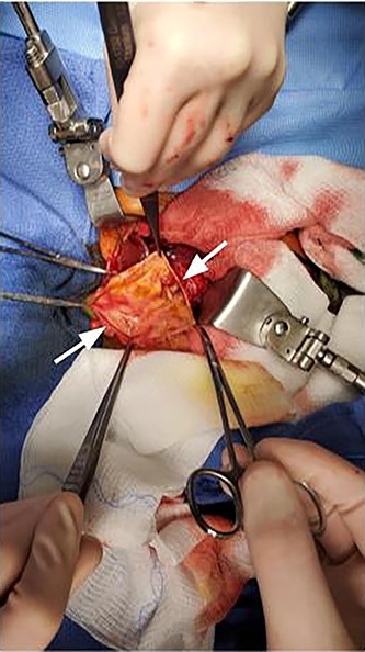 Intraoperative image showing incised cyst wall (arrows).