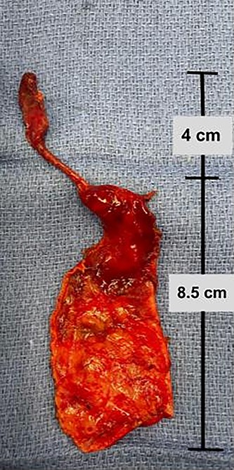 Complete excised gross specimen comprising choledochal cyst wall and gallbladder.