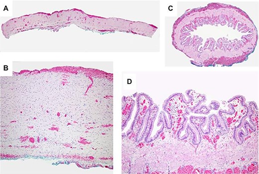 Light microscopy of resected specimen. A. Cross section of the choledochal cyst wall showing entirely denuded surface with absent mucosa. The surface of the cyst wall was congested and hemorrhagic without inflammation. B. The cyst wall is composed of quiescent, uniform fibrocytes. C. A cross section of the mildly dilated CBD with preserved intact mucosa. D. The biliary epithelium at higher power is well-developed and lacks atypia.