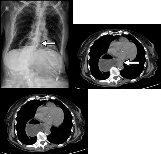 Chest X-ray with gas distension and the air-fluid level above the diaphragmatic domes and contrast-enhanced abdominal CT showing gastric volvulus in hiatal hernia.