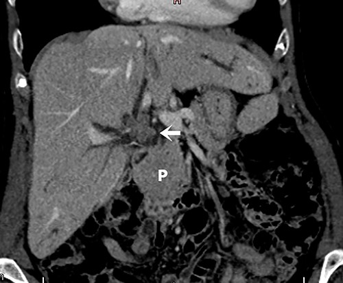 Cholangioresonance showing biliary tract dilatation due to intraductal lesion of the biliary tract, involving the confluence and the right hepatic duct (Bismuth IIIA).