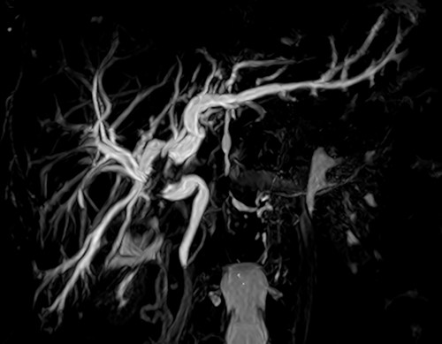 Abdominal tomography with intravenous contrast enhancement showing a solid and irregular nodule (white arrow) that caused retraction of the gallbladder bed and loss of the cleavage plane with the proper hepatic artery and portal vein, measuring 30 × 26 × 27 mm. The lesion is invading the biliary tract at the confluence of the hepatic ducts. There are no evident vascular invasion and no regional lymph node enlargement. The pancreas (P) is normal.