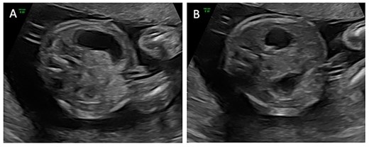 Transverse ultrasound images obtained at 21- and 2/7-weeks’ gestation demonstrating a dilated stomach (A) with possible ‘double-bubble’ sign (B).