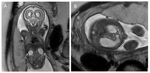 (A) T2-weighted coronal fetal MRI image demonstrating dilation of the stomach (solid arrow) and duodenum (dashed arrow). (B) T2-weighted transverse abdominal fetal MRI image demonstrating a dilated stomach in continuity with the dilated duodenum.