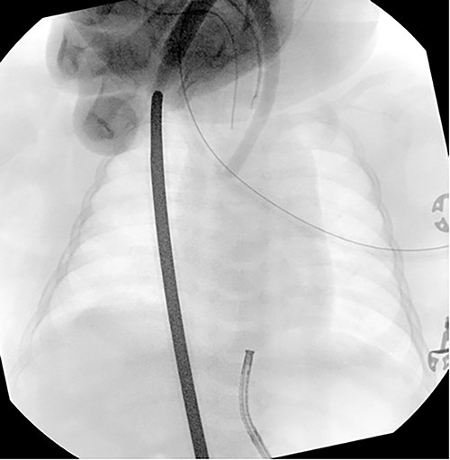 Esophageal gap study performed on day of life 15 demonstrating an estimated esophageal gap of ~6 cm.