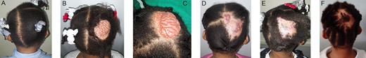 (A) NS is hidden by hair; (B) loosening of hair revealing NS; (C) NS prior to an excisional biopsy; (D) 57 days post-excision of and closure via a Rhombic flap; (E) 5 months post-excision; (F) 3 years post-excision.