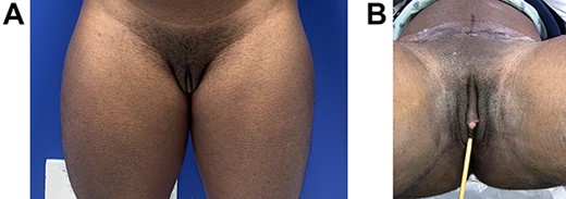 (A and B) A 34-year-old trans man prior to phalloplasty with latissimus dorsi flap and vaginal preservation. Previous double incision mastectomy for top surgery and a hysterectomy with oophorectomy had been done in the past.