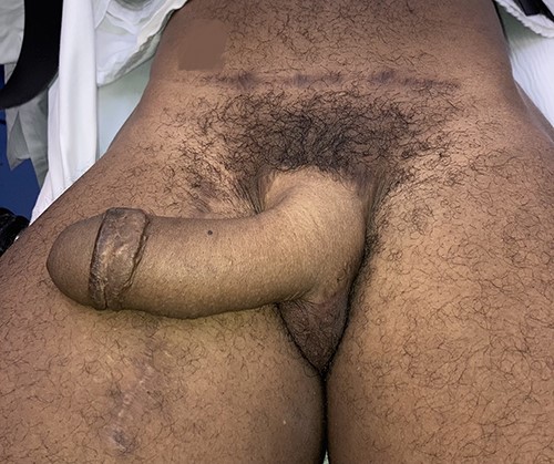 Patient 3 months postoperatively with viable neophallus using a split lateral latissimus dorsi myocutaneous flap without urethral lengthening for phalloplasty, glansplasty and scrotoplasty using labia majora flaps and preservation of the vaginal canal. One arterial and one venous anastomosis, and two neurorrhaphy with interposition nerve grafts to the ilioinguinal nerve and one clitoral nerve.