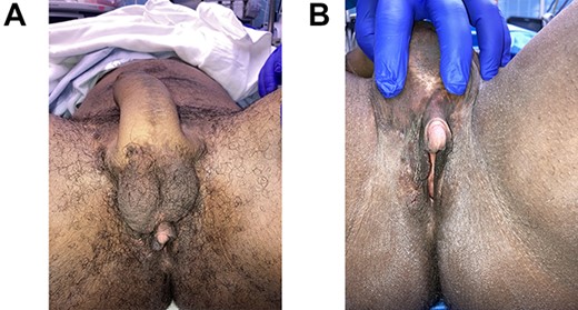 (A and B) Patient is shown 4 months following insertion of silicone testicular implants. Intact vaginal canal posterior to clitoris.