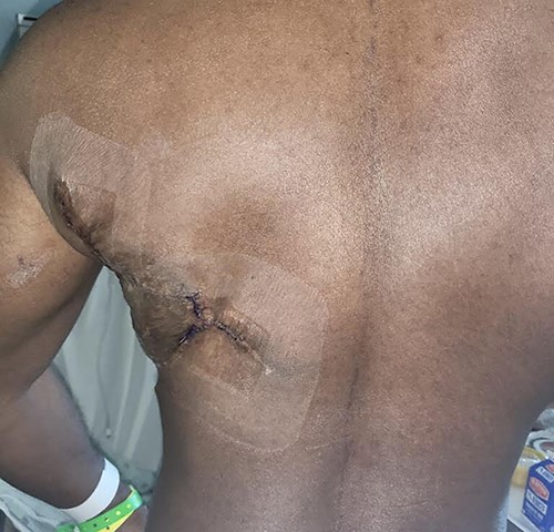 The patient’s donor site is shown 10 months postoperative following a left latissimus dorsi myocutaneous flap following one serial excision of the skin grafted donor site.