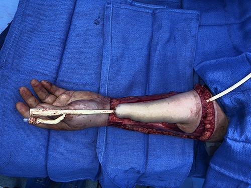 Tubed radial forearm flap for phalloplasty construction prior to flap transfer.