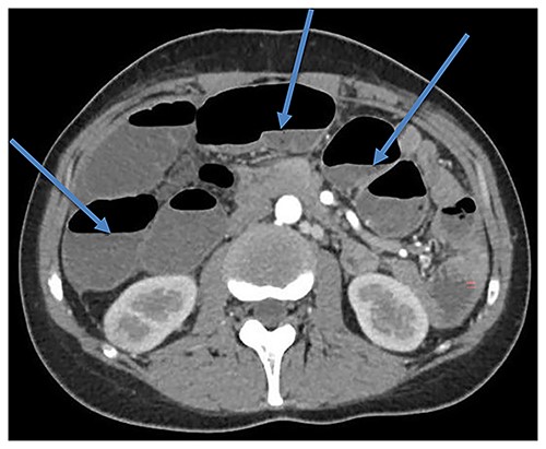 CT scan showing bowel dilatation (air-fluid levels are marked with arrows).