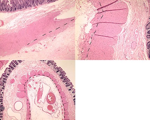 Histopathological examination showing abnormal changes of colonic muscular layer; particularly, abundant areas with minimal development of the outer muscular layer (dashed line shows the boundary between the muscular layers).