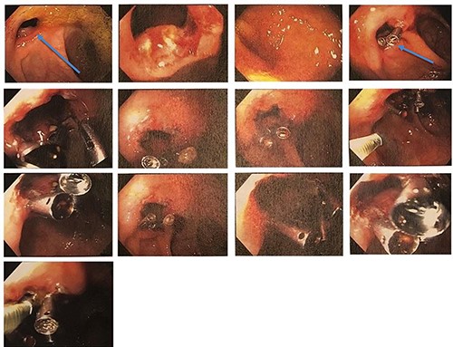 Colonoscopy disclosed anastomotic stricture, ~5 mm in diameter (labelled with an arrow); endoscopic dilation was done.