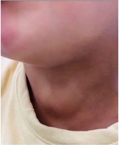The mass on the right side of the first patient’s neck.