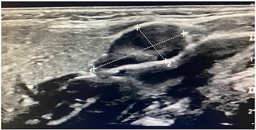 Ultrasonogram of the first patient.