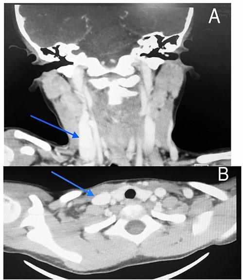 CT scan of the first patient in coronal view (A) and axial view (B) with blue indicate internal jugular phlebectasia.