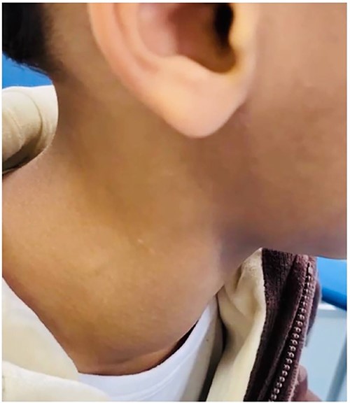 The mass on the right side of the second patient’s neck.
