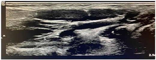 Ultrasonogram of the second patient.