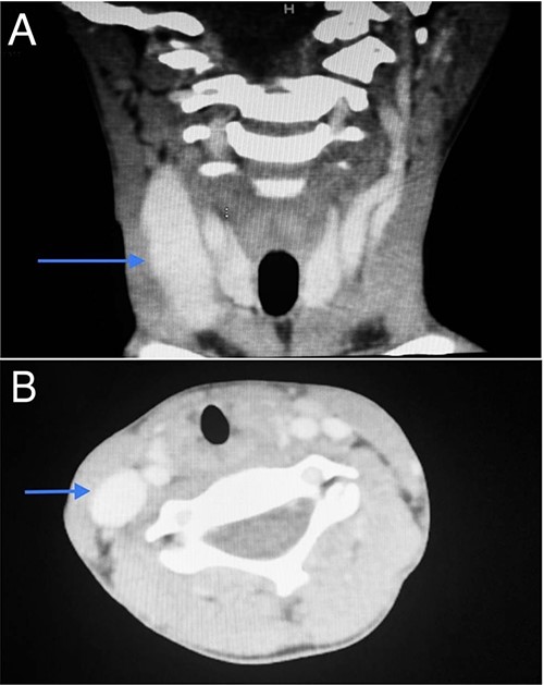 CT scan of the second patient in coronal view (A) and axial view (B) with blue indicate internal jugular phlebectasia.