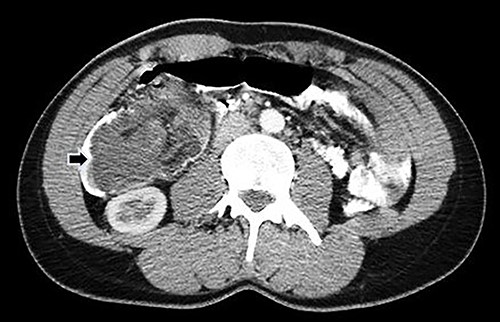 Abdominal CT with oral and IV contrast, axial view; tumoral mass and intussusception (arrow).