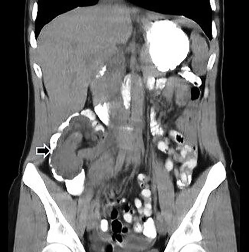 Abdominal CT with oral and IV contrast, coronal view; tumoral mass and intussusception (arrow).