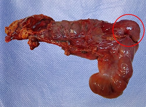 Surgical specimen; red circle indicating tumoral mass and vestiges of the intussusceptive process.