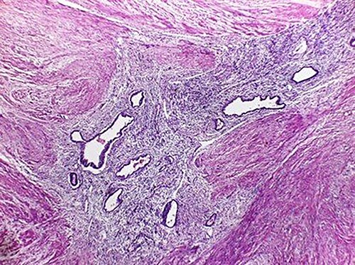 Low magnification image (4x); endometrial glands and stroma in the middle of the external muscular layer of the colon.