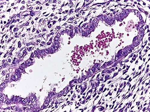 High magnification image (40x); endometrial gland and stroma without atypia. Erythrocytes within the lumen of the gland.