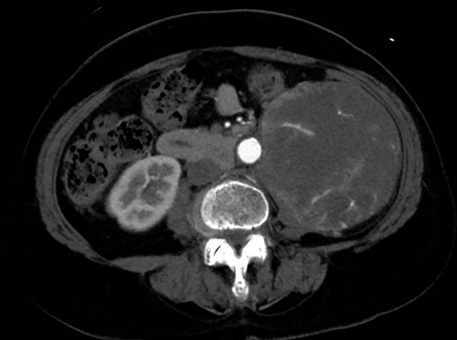 A giant retroperitoneal tumor.
