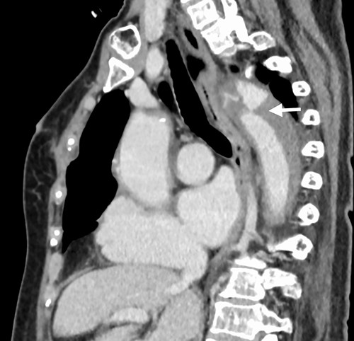 Arrow shows ULP at the distal arch.