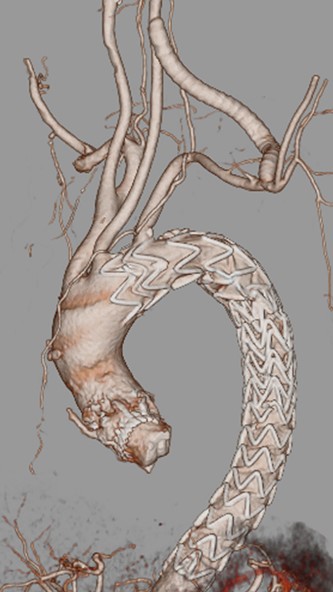 After TEVAR 3DCT VR.