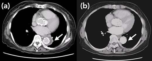 Arrow shows false lumen. (a) One week after TEVAR. False lumen still remains. (b) One year after TEVAR. False lumen has almost disappeared.