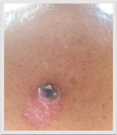 Nodular skin tumor of the back of a 69-year-old man.