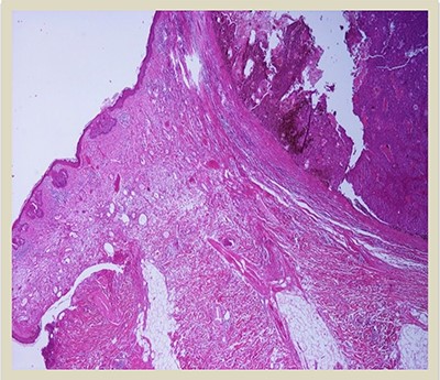 H–E × 2: Collision tumor: in the right side of the photo is shown the dermal squamomelanocytic tumor component and in the left side the superficial basal cell carcinoma (H–E stain ×2 magnification).