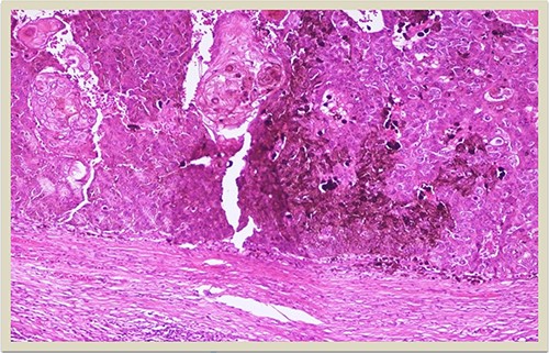 H–E × 10: Higher magnification of the dermal squamomelanocytic tumor showing admixed malignant malanocytes and keratinizing squamous cell carcinoma cells (H–E stain ×10 magnification).
