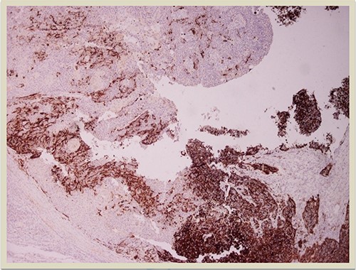 HMB45 × 4: HMB45 immunostain highlights the malignant melanocytic component ( ×10 magnification).