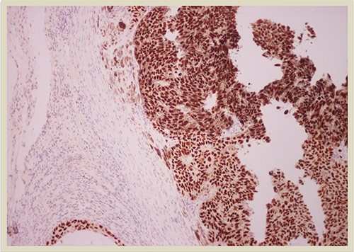 p63 × 10: p63 immunostain confirms the presence of squamous cell carcinoma component (×10 magnification).