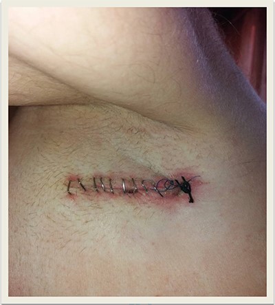 Axillary lymph node dissection scar.