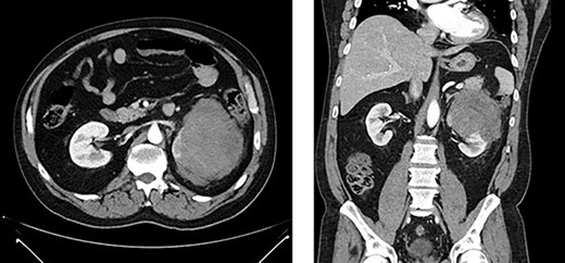 Left renal mass measuring 11 × 9 × 7cm in transverse (left) and coronal (right) planes.
