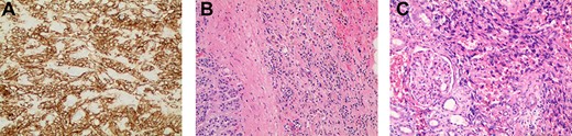 (A) Immunostaining for CD31 (100×) strongly marked lesional cells, supporting the diagnosis of AS and excluding sarcomatoid RCC; (B) routine H&E-stained section (100×) demonstrating an infiltrative pattern sarcomatoid tumor with variable cellularity and characteristic slit-like spaces, including red blood cells, characteristic of AS; benign adrenal tissue is visible on the left; (C) routine H&E-stained section (100×x) demonstrating angiosarcomatoid pattern with benign glomeruli.