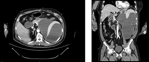 Appearance of effusion in the left retroperitoneal space in transverse (left) and coronal (right) planes on CT; it can be seen encroaching on the spleen; subsequent cytology ruled of malignant effusion.