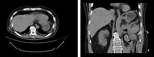First appearance of multiple liver lesions suspicious for metastasis in transverse (left) and coronal (right) planes on CT; reduction of retroperitoneal effusion can also be seen.