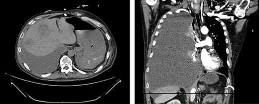 CT demonstrates growth of effusion into the entirety of the right hemithorax with mass effect shifting all thoracic contents to the left (left); later cytology ruled out malignant effusion; substantial increase in liver metastatic lesions can also be seen when compared to previous images from 2 months prior.