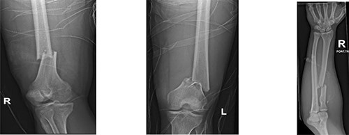 Radiographs show bilateral femoral and right radius fractures. R: right, L: left.